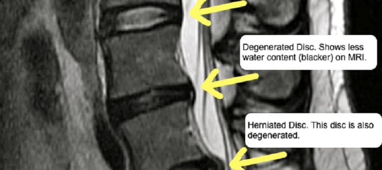 Degenerative Disc Disease | Wake Spine & Pain Specialists